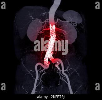 CTA whole aorta with Abdominal aorta stent graft compare 3D rendering image in case  abdominal aortic aneurysms. Stock Photo