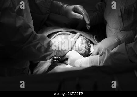 Cesarean Section, close up of the baby being removed from mothers womb during surgery Stock Photo