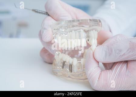 the orthodontist holds a model of teeth with implants in his hand and ...