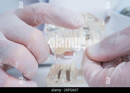 the orthodontist holds a model of teeth with implants in his hand and ...