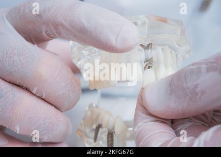 the orthodontist holds a model of teeth with implants in his hand and ...