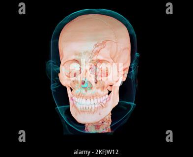 Fractured skull, 3D CT scan Stock Photo