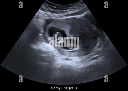 Foetus at 10 weeks, ultrasound scan Stock Photo