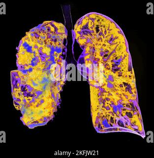 Pneumonia, 3D CT scan Stock Photo