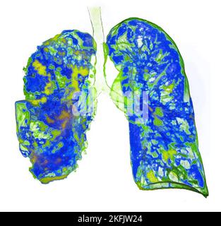 Pneumonia, 3D CT scan Stock Photo