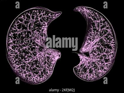 Healthy lungs, 3D CT scan Stock Photo