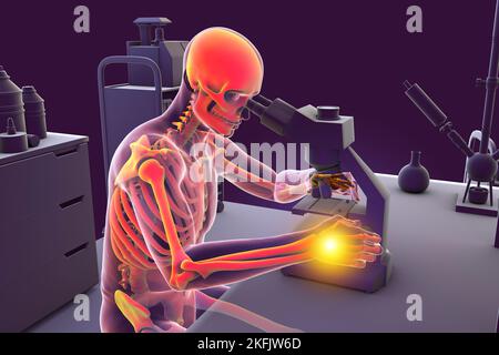 Carpal tunnel syndrome in laboratory workers, illustration Stock Photo