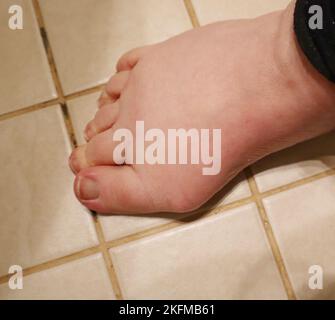 bunion on a woman's fot Stock Photo