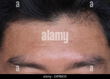 Skin creases or wrinkles at the forehead of Southeast Asian, Myanmar or Burmese man. Symptom of aging. Stock Photo