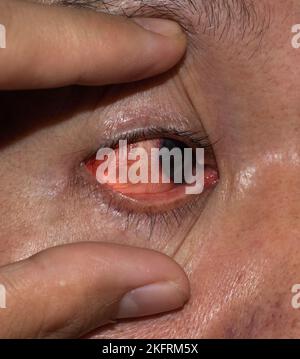 Corneal infection or ulcer called keratitis in Asian old man. Stock Photo