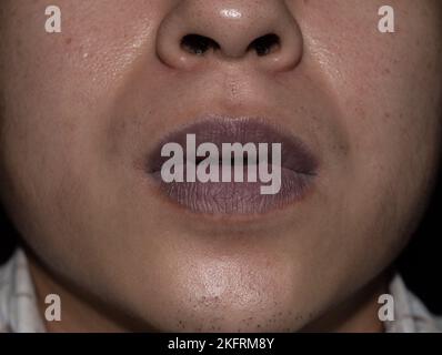 Central cyanosis in the lips of Southeast Asian young man with congenital heart disease. Stock Photo