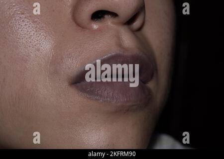 Central cyanosis in the lips of Southeast Asian young man with congenital heart disease. Stock Photo