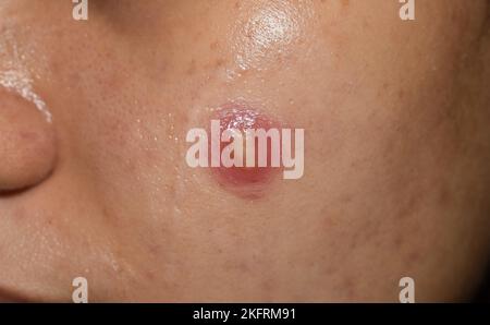 Cystic acne on the face of Southeast Asian man. Large pustule. Stock Photo