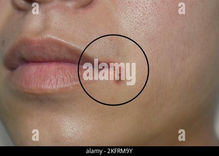 Angular stomatitis or angular cheilitis or perleche in asian young man. Common inflammatory condition caused by iron, zinc or B12 deficiency, or repet Stock Photo