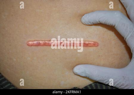 Neat, tidy and clean keloid scar. Straight surgical incision. Top view. Stock Photo
