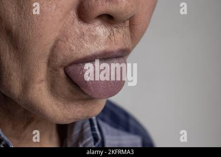 Central cyanosis in Southeast Asian old man with congenital heart disease. Stock Photo