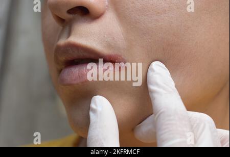 Angular stomatitis or angular cheilitis or perleche in asian young man. Mouth ulcer. Common inflammatory condition caused by iron, zinc or B12 deficie Stock Photo