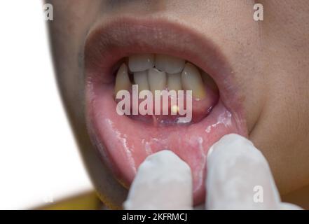 Periodontal abscess. Periapical type. Small pocket of pus in the tissues of the gum. Stock Photo