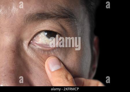 Pale skin of Asian man. Sign of anemia. Pallor at eyelid. Closeup view. Stock Photo