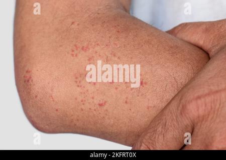 Multiple itchy mosquito or insect bite wheals; red spots on the forearm of Southeast Asian, Chinese adult man. Stock Photo