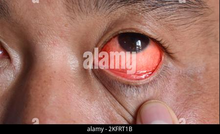 Corneal infection or ulcer called keratitis in Asian Chinese man. Stock Photo