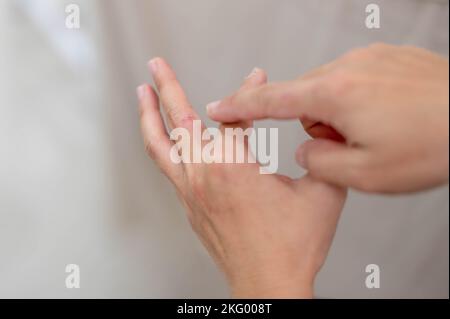 Patient Skin Is Ripped Female hand pointing to dry, cracked skin on cuticles, skin is torn and ...