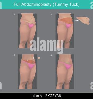 Full Abdominoplasty. Explain to understand on steps a surgery out of body belly fat. Stock Vector