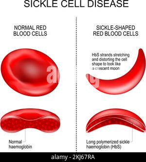 Shape of red blood cell. Sickle cell, Echinocyte, Spherocyte ...