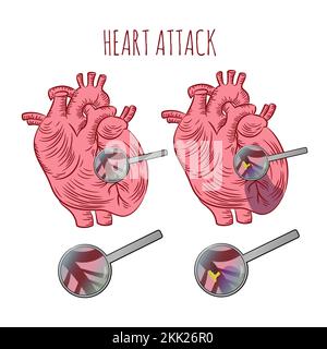 HEART ATTACK Atherosclerosis Chronic Disease Medicine Education Diagram Vector Scheme Human Hand Drawn Vector Illustration Stock Vector