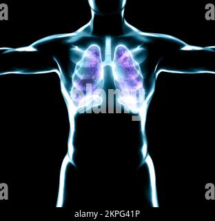 Human anatomy, problems with the respiratory system, severely damaged lungs. Bilateral pneumonia. Covid-19, coronavirus. Patient and smoke. Smoker Stock Photo