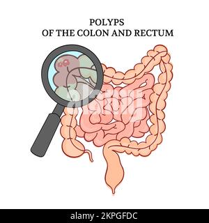 POLYPS OF THE COLON Intestines Medicine Anatomy University Student School Education Teaching Scheme Human Cartoon Hand Drawn Clip Art Vector Illustrat Stock Vector