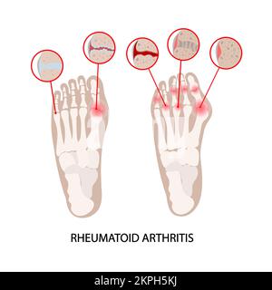 RHEUMATOID DISEASE Arthritis Scheme Of Lesions Of Human Hands For ...