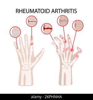 RHEUMATOID DISEASE Arthritis Scheme Of Lesions Of Human Hands For ...