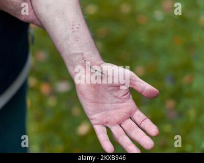 marks of a chainsaw on a male damaged arm, outdoor closeup Stock Photo