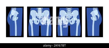 Set of X-Ray Pelvis and Femur Skeleton Hip Human body Bones adult people roentgen front back side view. 3D realistic flat blue color concept Vector illustration of medical anatomy isolated on black Stock Vector