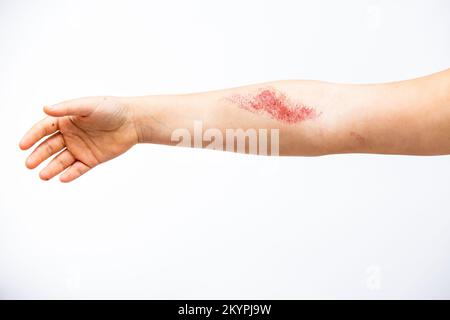 Children's hand burn. Children's hand with a burnt wound on a white background.Close up. Stock Photo