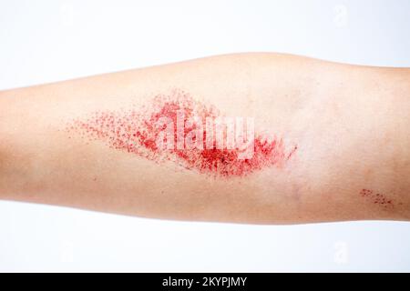 Children's hand burn. Children's hand with a burnt wound on a white background.Close up. Stock Photo