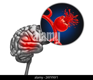Ruptured brain Aneurysm as a medical concept with a bulging blood vessel as a ballooning artery with a rupture bleeding blood and causing a risk Stock Photo