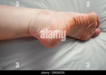 Foot of person with Raynaud's and Ehlers-Danlos syndrome (EDS) with damaged very dry skin cracking on heel Cracked heel Rare diseases Stock Photo