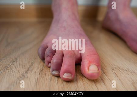 Leg of person with orthostatic intolerance syndrome with purple  discoloration upon standing, Dysautonomia blood pooling in legs Livedo  reticularis Stock Photo - Alamy