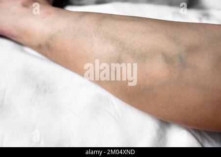 Leg with varicose veins close up Varicose veins in leg during sitting, veins visible under the skin, Sitting person with varicose veins in leg Stock Photo