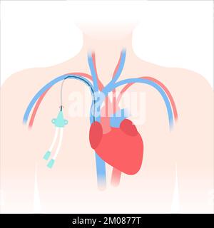 Tunneled central line venous catheter medical diagram Stock Vector