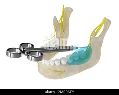 Mandibular arch with buccal nerve block. Types of dental anesthesia concept. Stock Photo