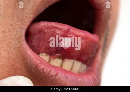 Aphthous Ulcer. Close-up Of A Large Aphthous Ulcer (mouth Ulcer) Seen ...