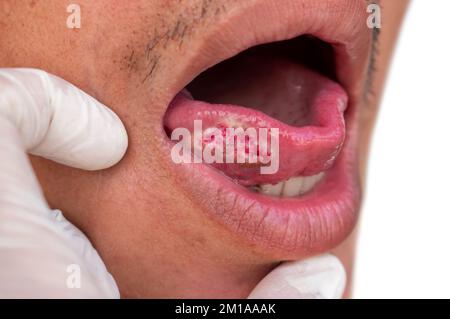 Squamous cell carcinoma of tongue. Oral cancer or malignant tumor of Asian male patient. Stock Photo