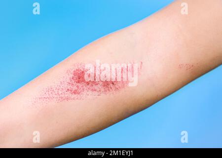 Children's hand burn. Children's hand with a burnt wound on a blu background.Close up Stock Photo