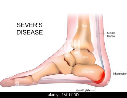 Severs disease. calcaneus apophysitis. inflammation at the back of the heel growth plate. Foot anatomy. side view of a Human foot Stock Vector