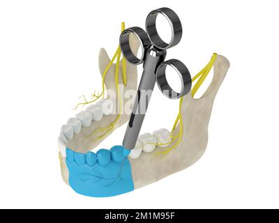 Mandibular arch with incisive nerve block. Types of dental anesthesia concept. Stock Photo