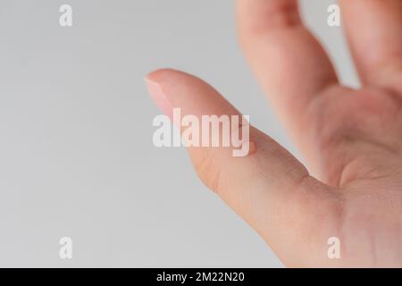 Wart on hand. The concept of treating warts and other skin defects. Close-up of a wart on a finger, a benign growth on human skin. Stock Photo