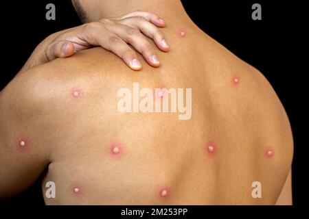 Man affected by new monkeypox dangerous disease on his back with painful rash and blisters . Person with itch red spots on the skin with monkey smallp Stock Photo